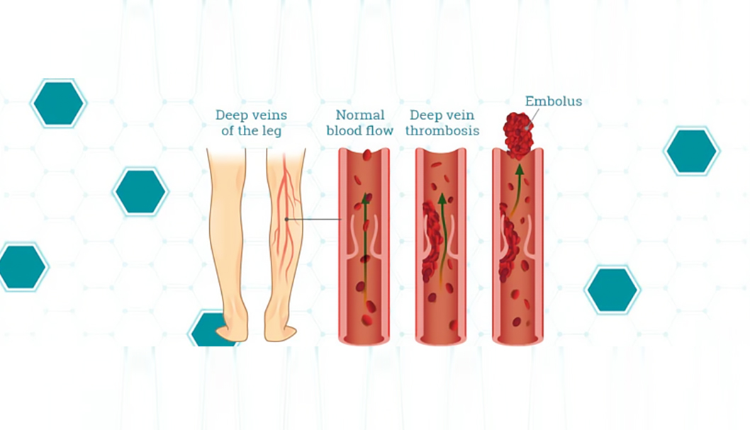 DVT-sleeve