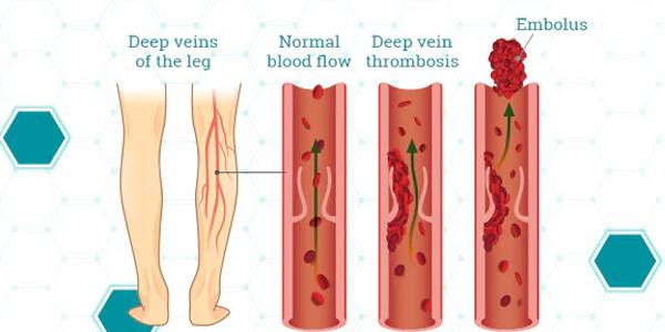 Understanding the Importance of Compression Therapy in VTE Prevention