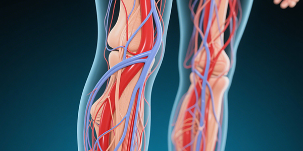 Understanding the Importance of Compression Therapy in VTE Prevention